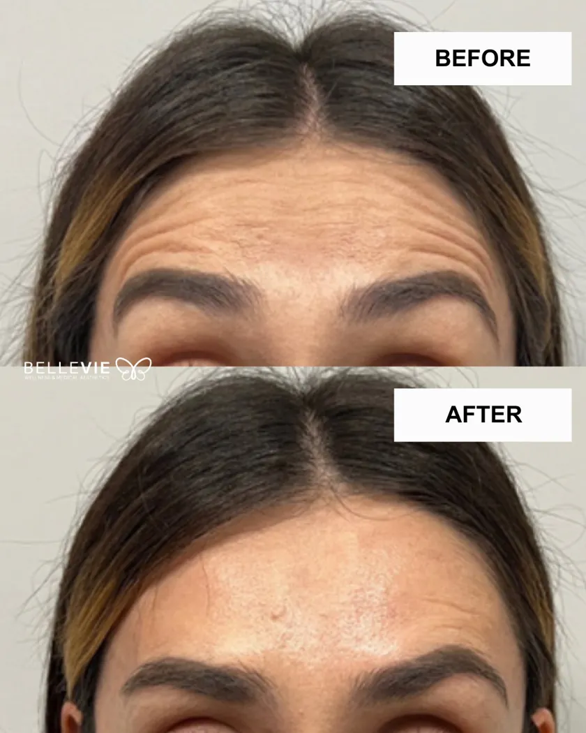 Before and after — forehead lines smoothed with wrinkle relaxer at Belle Vie
