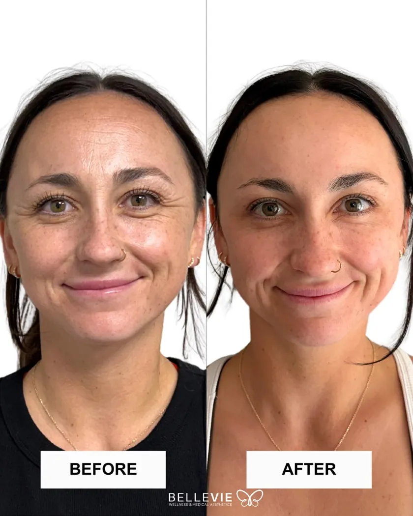 Before and after — forehead lines and crow's feet softened with wrinkle relaxer at Belle Vie