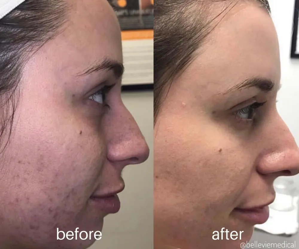 Microneedling before and after — cheek texture and acne scarring
