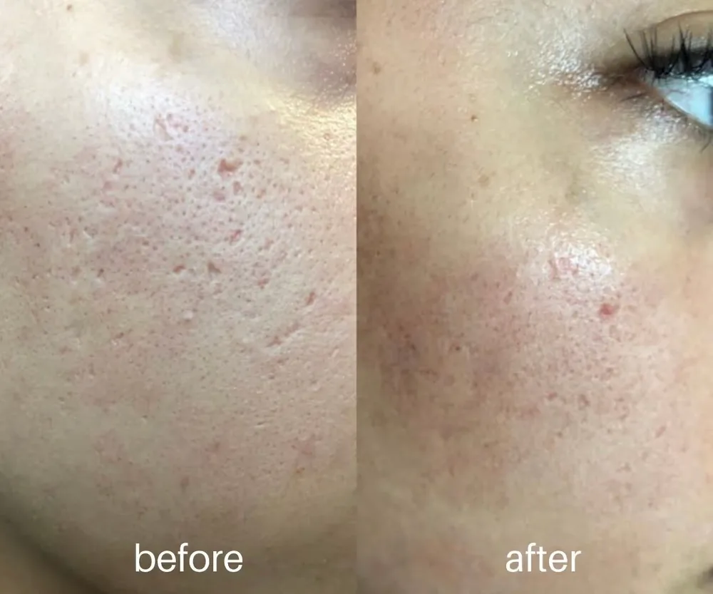 Microneedling before and after — pores and skin texture