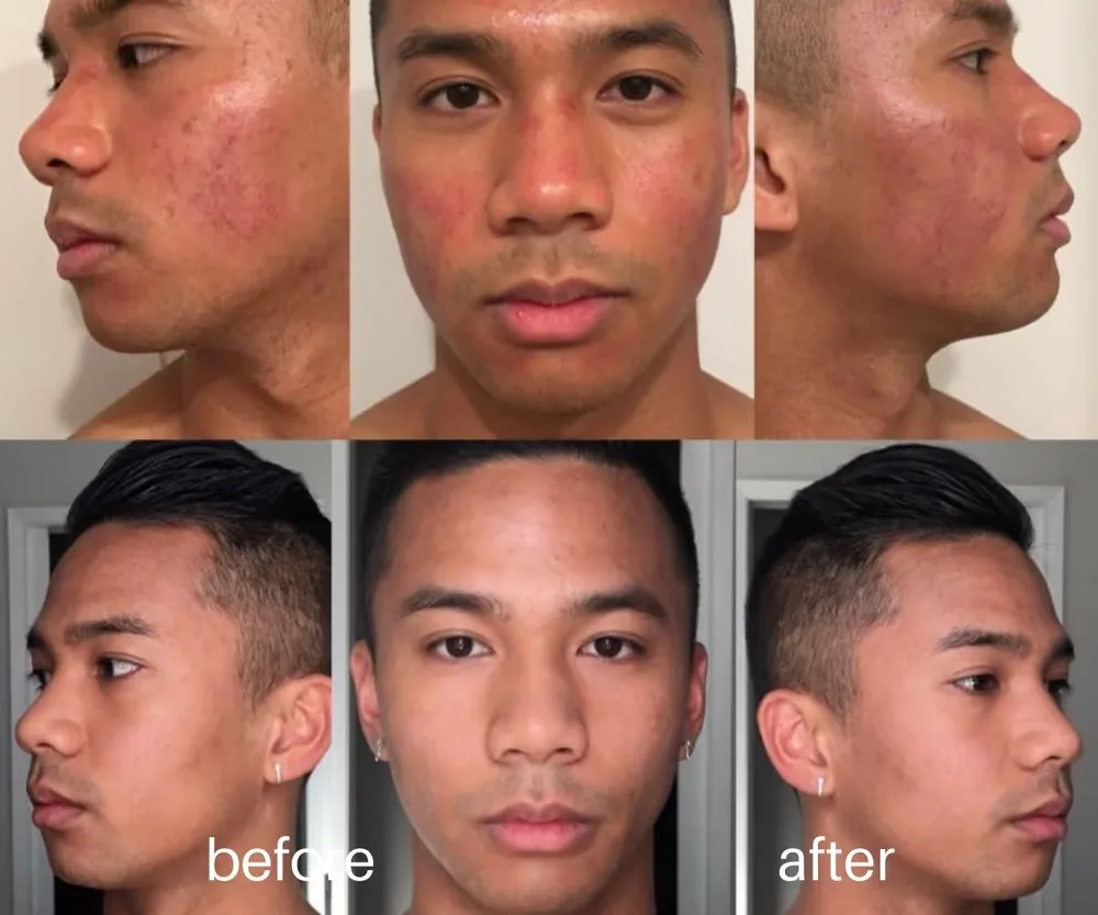 Microneedling before and after — overall skin clarity