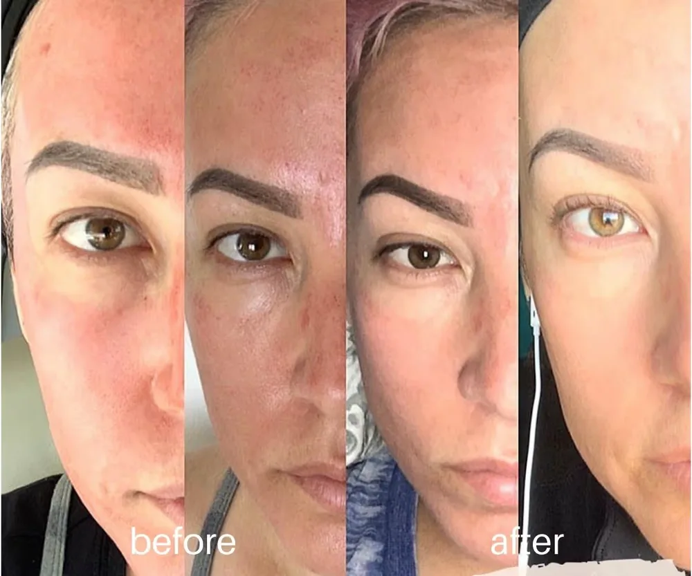 Microneedling before and after — skin tone and fine lines