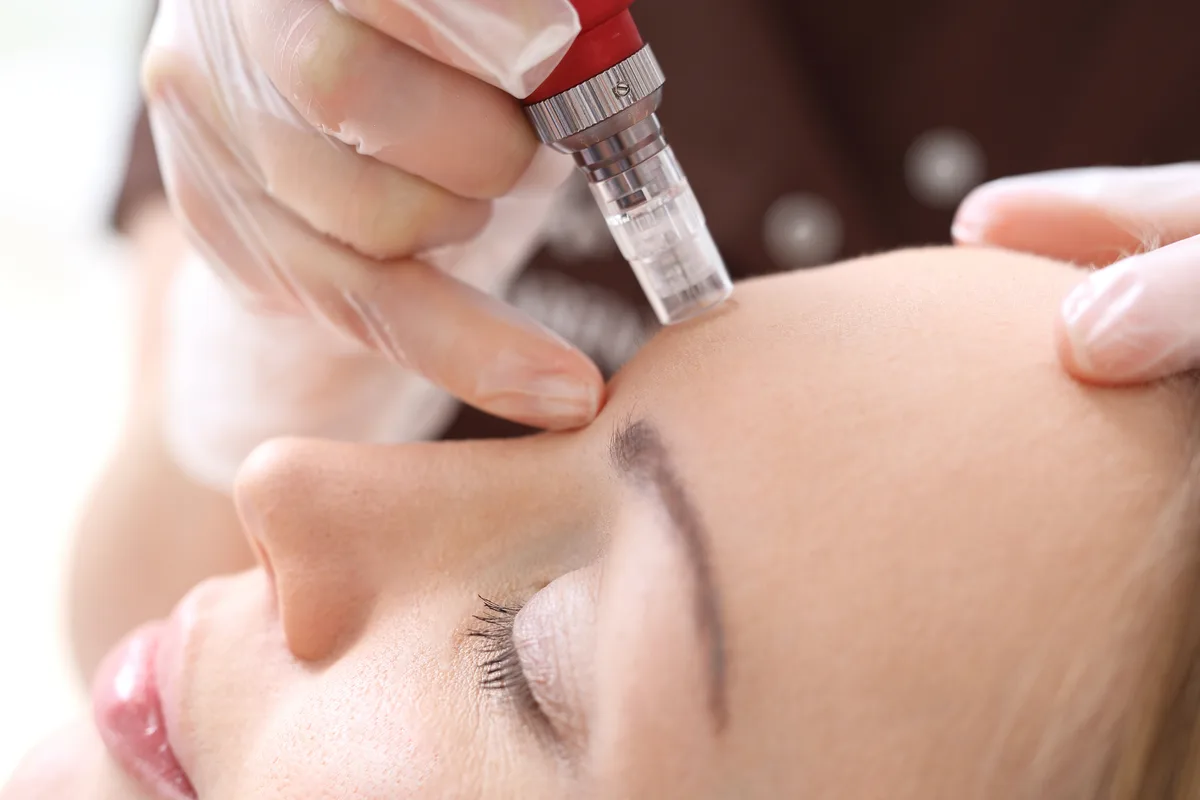 Microneedling treatment at Belle Vie